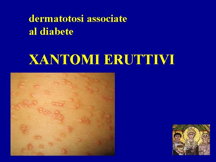 dermatotosi associate al diabete XANTOMI ERUTTIVI 