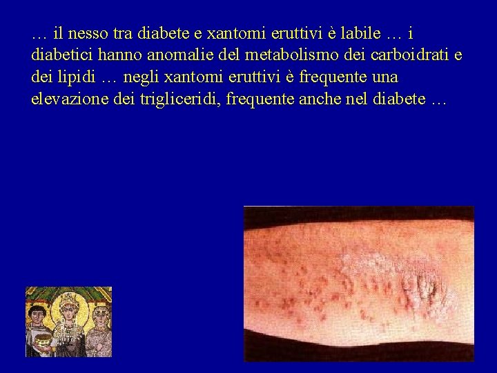 … il nesso tra diabete e xantomi eruttivi è labile … i diabetici hanno