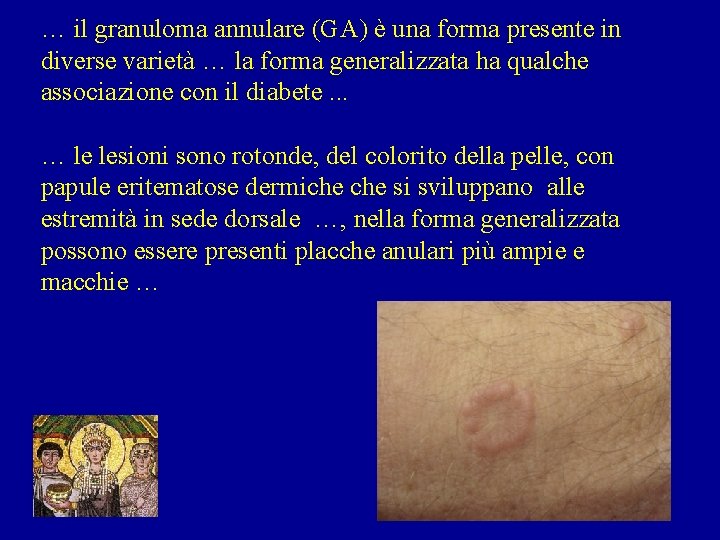 … il granuloma annulare (GA) è una forma presente in diverse varietà … la