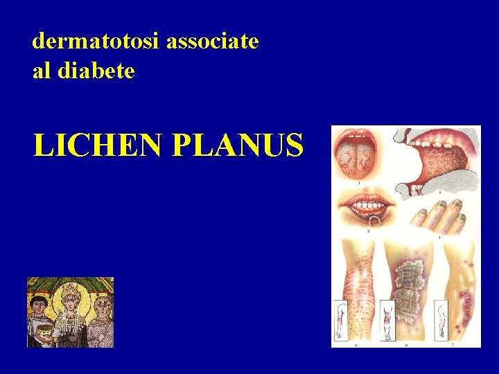 dermatotosi associate al diabete LICHEN PLANUS 