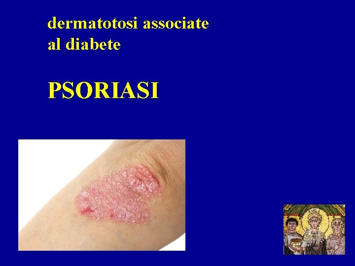 dermatotosi associate al diabete PSORIASI 