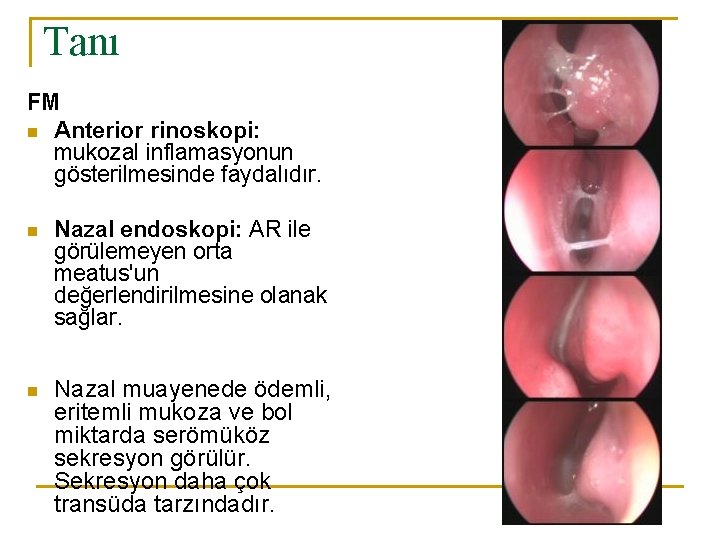 Tanı FM n Anterior rinoskopi: mukozal inflamasyonun gösterilmesinde faydalıdır. n Nazal endoskopi: AR ile