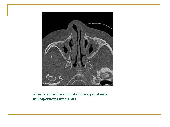 Kronik rinosinüzitli hastada aksiyel planda mukoperiostal hipertrofi 