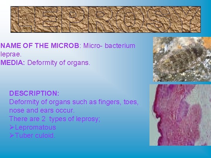 NAME OF THE MICROB: Micro- bacterium leprae. MEDIA: Deformity of organs. DESCRIPTION: Deformity of