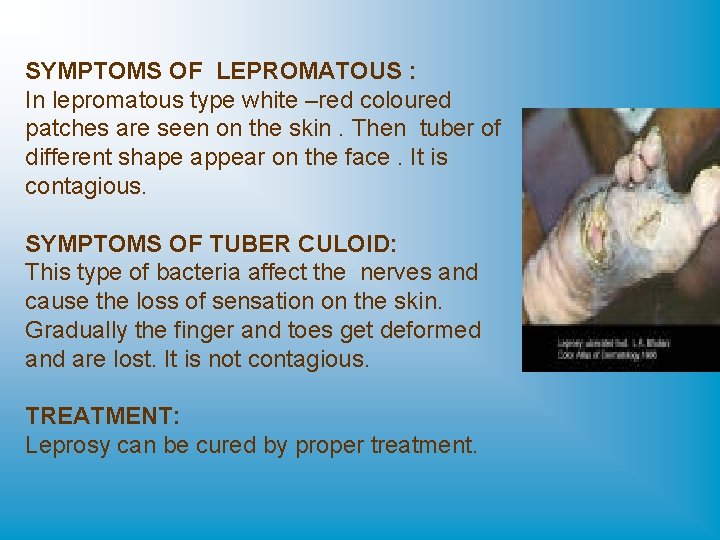 SYMPTOMS OF LEPROMATOUS : In lepromatous type white –red coloured patches are seen on