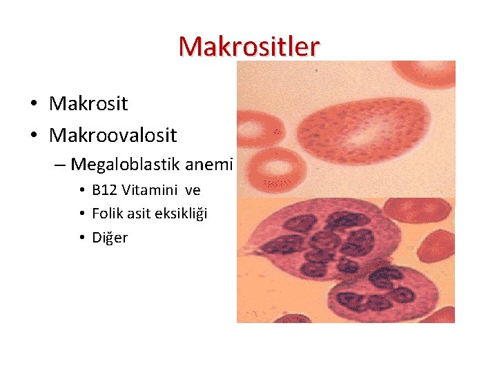 Makrositler • Makrosit • Makroovalosit – Megaloblastik anemi • B 12 Vitamini ve •