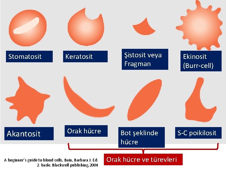 Stomatosit Keratosit Akantosit Orak hücre A beginner’s guide to blood cells, Bain, Barbara J.