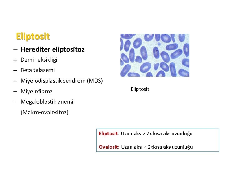 Eliptosit – Herediter eliptositoz – Demir eksikliği – Beta talasemi – Miyelodisplastik sendrom (MDS)