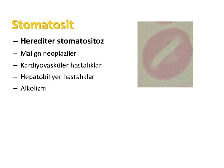 Stomatosit – Herediter stomatositoz – Malign neoplaziler – Kardiyovasküler hastalıklar – Hepatobiliyer hastalıklar –