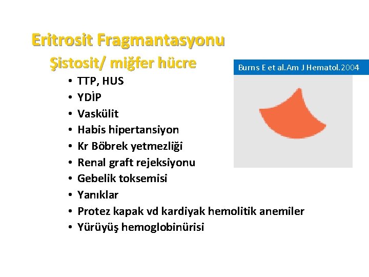 Eritrosit Fragmantasyonu Şistosit/ miğfer hücre • • • Burns E et al. Am J