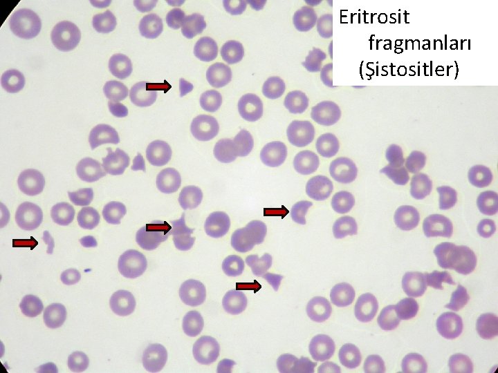 Eritrosit fragmanları (Şistositler) 