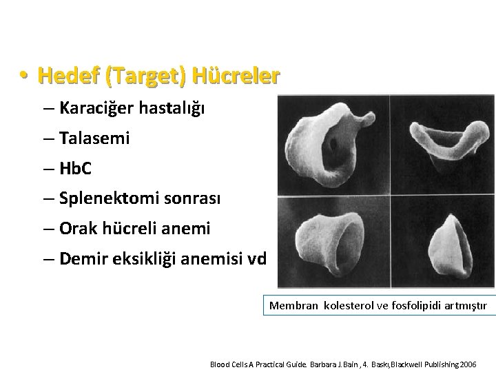  • Hedef (Target) Hücreler – Karaciğer hastalığı – Talasemi – Hb. C –