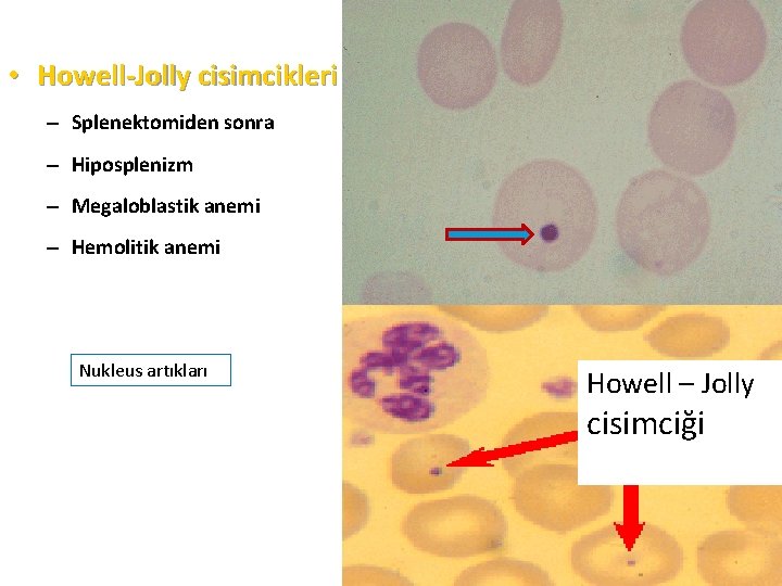  • Howell-Jolly cisimcikleri – Splenektomiden sonra – Hiposplenizm – Megaloblastik anemi – Hemolitik