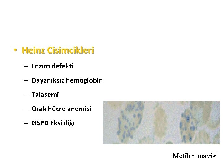  • Heinz Cisimcikleri – Enzim defekti – Dayanıksız hemoglobin – Talasemi – Orak