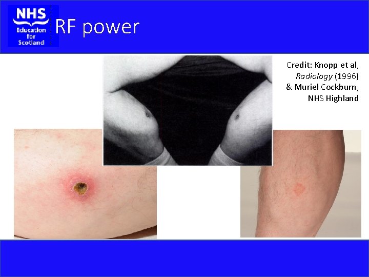 RF power Credit: Knopp et al, Radiology (1996) & Muriel Cockburn, NHS Highland 