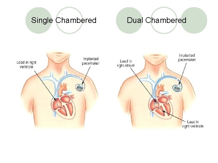 Single chamber heart