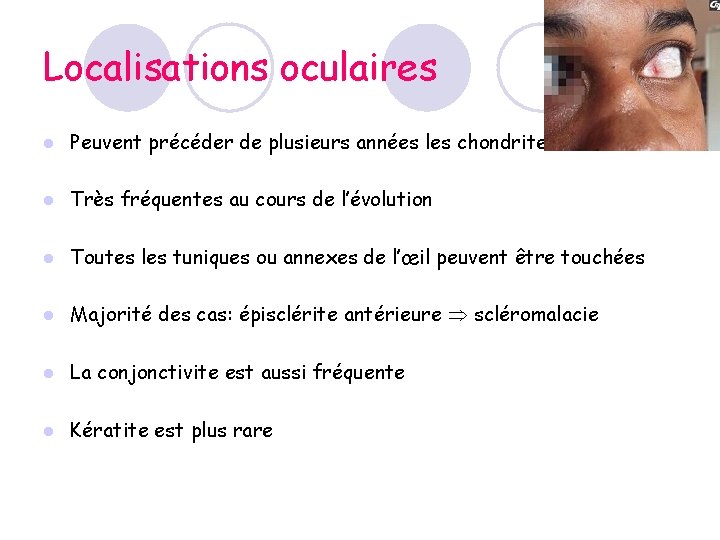 Localisations oculaires l Peuvent précéder de plusieurs années les chondrites l Très fréquentes au Localisations oculaires l Peuvent précéder de plusieurs années les chondrites l Très fréquentes au
