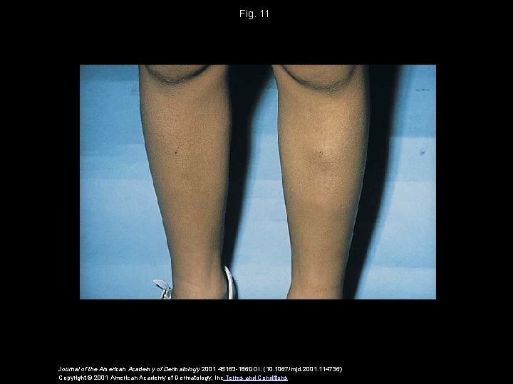 Fig. 11 Journal of the American Academy of Dermatology 2001 45163 -186 DOI: (10.