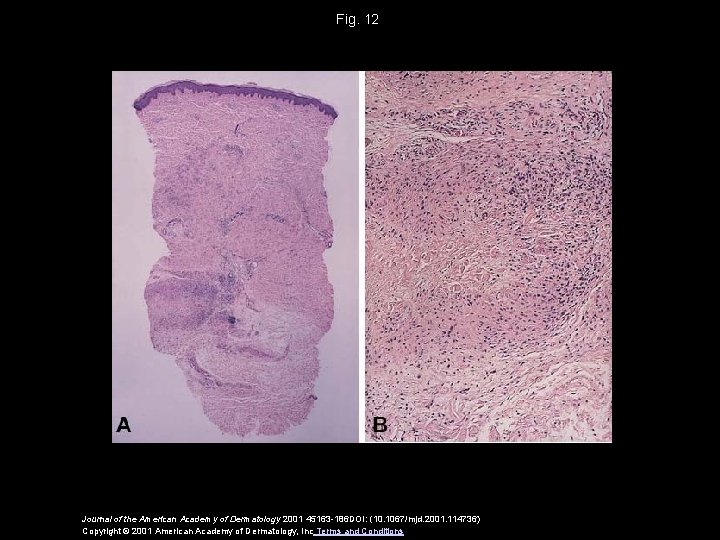 Fig. 12 Journal of the American Academy of Dermatology 2001 45163 -186 DOI: (10.