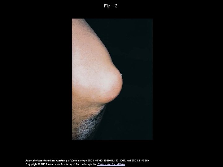 Fig. 13 Journal of the American Academy of Dermatology 2001 45163 -186 DOI: (10.