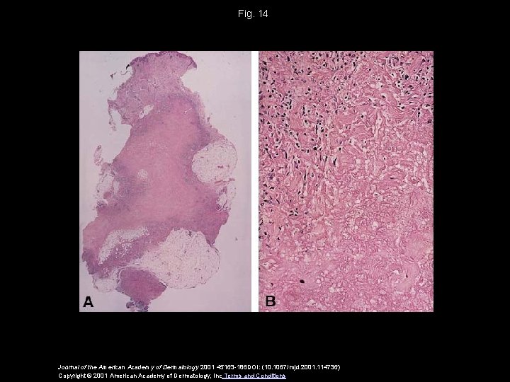 Fig. 14 Journal of the American Academy of Dermatology 2001 45163 -186 DOI: (10.