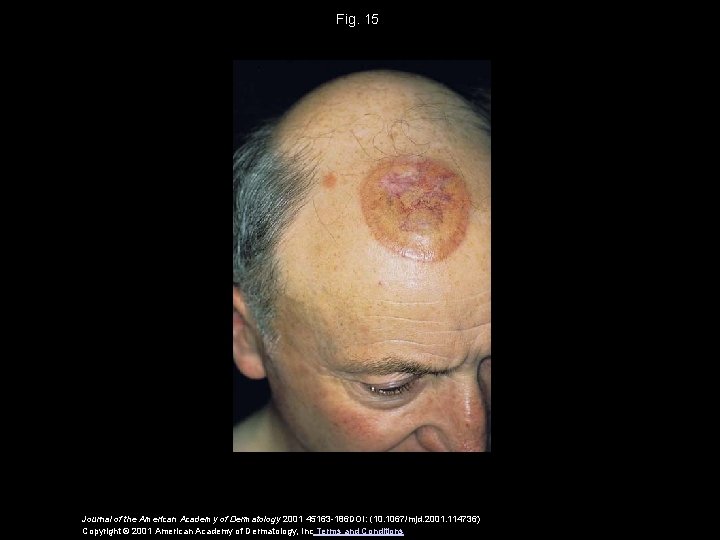 Fig. 15 Journal of the American Academy of Dermatology 2001 45163 -186 DOI: (10.