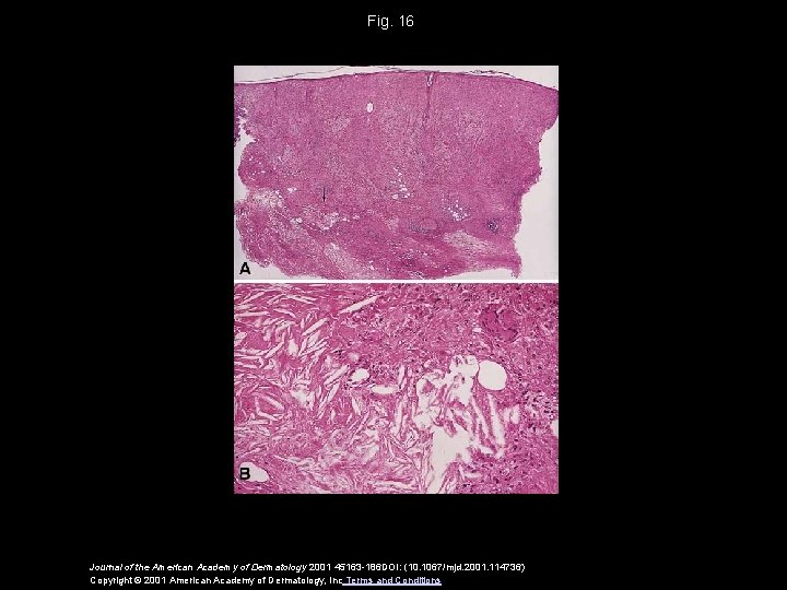 Fig. 16 Journal of the American Academy of Dermatology 2001 45163 -186 DOI: (10.