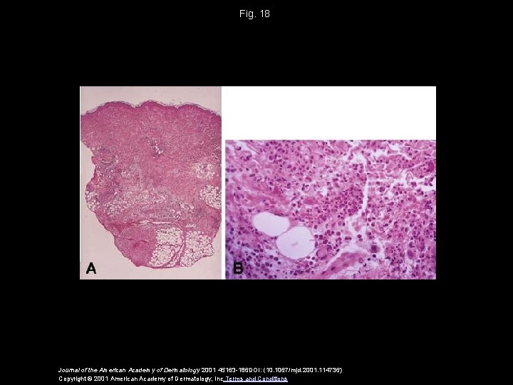 Fig. 18 Journal of the American Academy of Dermatology 2001 45163 -186 DOI: (10.