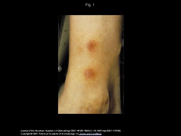 Fig. 1 Journal of the American Academy of Dermatology 2001 45163 -186 DOI: (10.