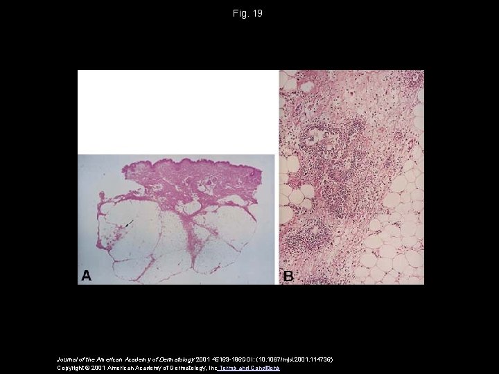 Fig. 19 Journal of the American Academy of Dermatology 2001 45163 -186 DOI: (10.