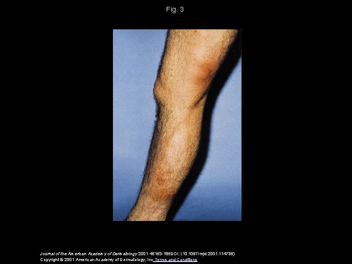 Fig. 3 Journal of the American Academy of Dermatology 2001 45163 -186 DOI: (10.