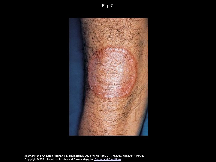 Fig. 7 Journal of the American Academy of Dermatology 2001 45163 -186 DOI: (10.