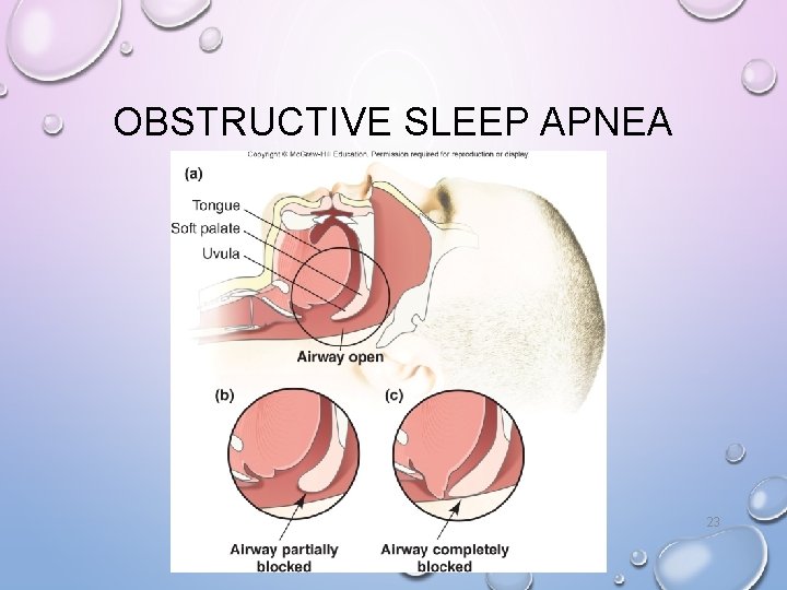 OBSTRUCTIVE SLEEP APNEA 23 OBSTRUCTIVE SLEEP APNEA 23