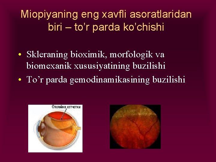 Miopiyaning eng xavfli asoratlaridan biri – to’r parda ko’chishi • Skleraning bioximik, morfologik va