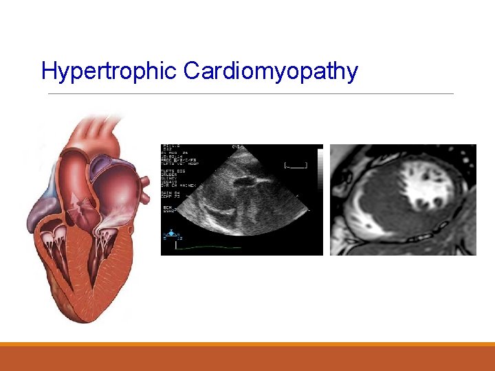 Hypertrophic Cardiomyopathy 