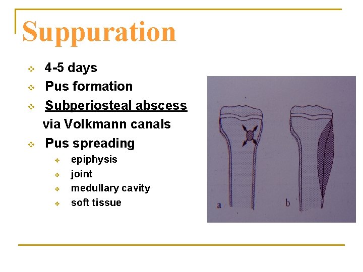 Suppuration v v 4 -5 days Pus formation Subperiosteal abscess via Volkmann canals Pus