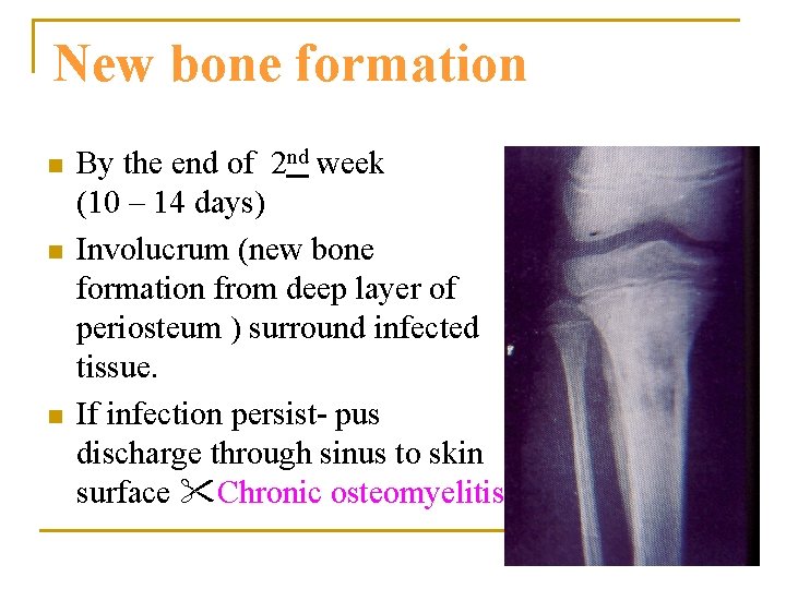 New bone formation n By the end of 2 nd week (10 – 14