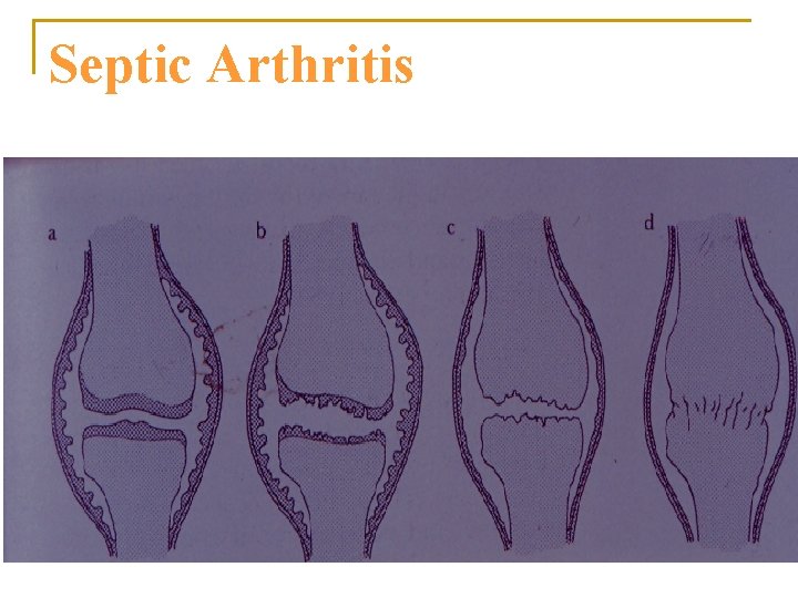 Septic Arthritis 