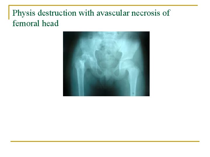 Physis destruction with avascular necrosis of femoral head 