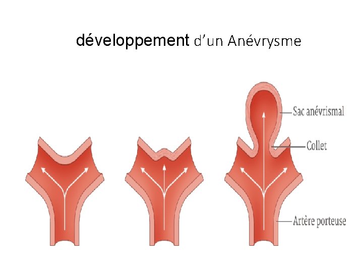 développement d’un Anévrysme 