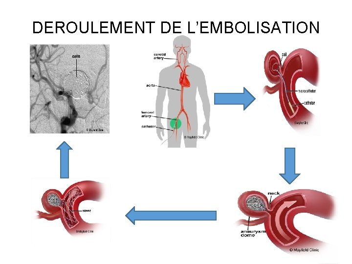 DEROULEMENT DE L’EMBOLISATION 