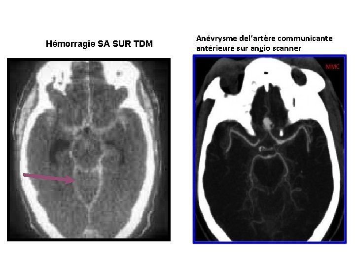 Hémorragie SA SUR TDM Anévrysme del’artère communicante antérieure sur angio scanner 