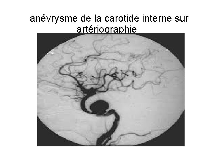 anévrysme de la carotide interne sur artériographie 