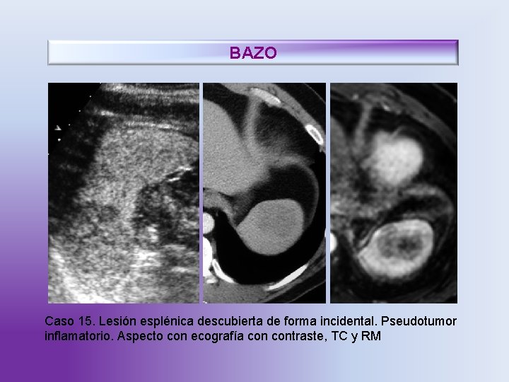 BAZO Caso 15. Lesión esplénica descubierta de forma incidental. Pseudotumor inflamatorio. Aspecto con ecografía