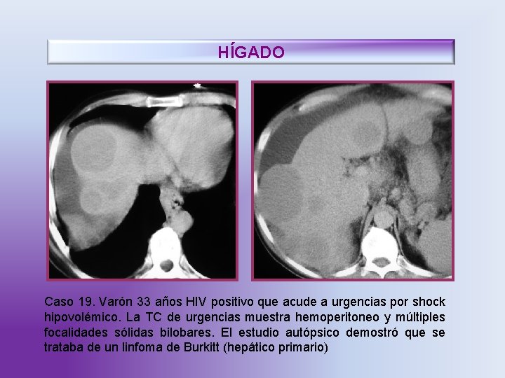 HÍGADO Caso 19. Varón 33 años HIV positivo que acude a urgencias por shock