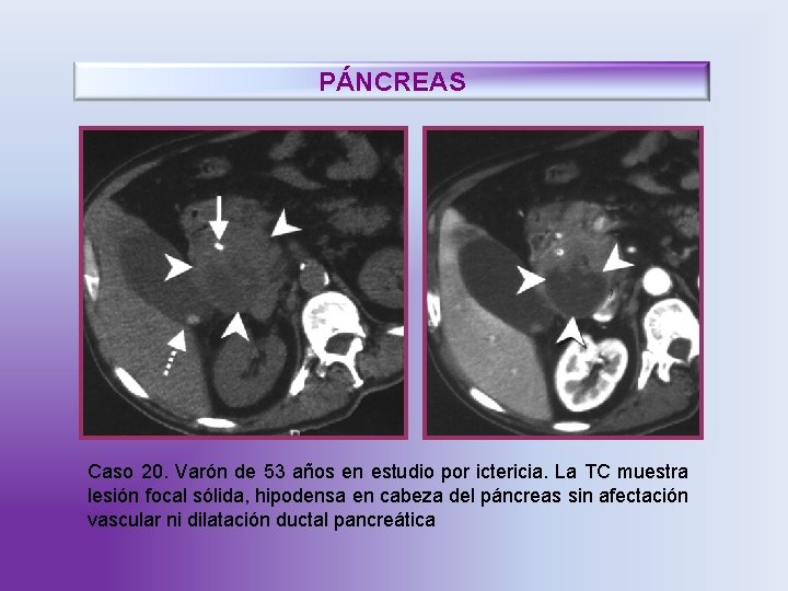 PÁNCREAS Caso 20. Varón de 53 años en estudio por ictericia. La TC muestra