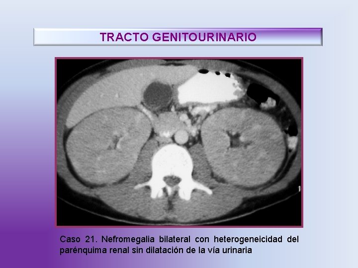 TRACTO GENITOURINARIO Caso 21. Nefromegalia bilateral con heterogeneicidad del parénquima renal sin dilatación de