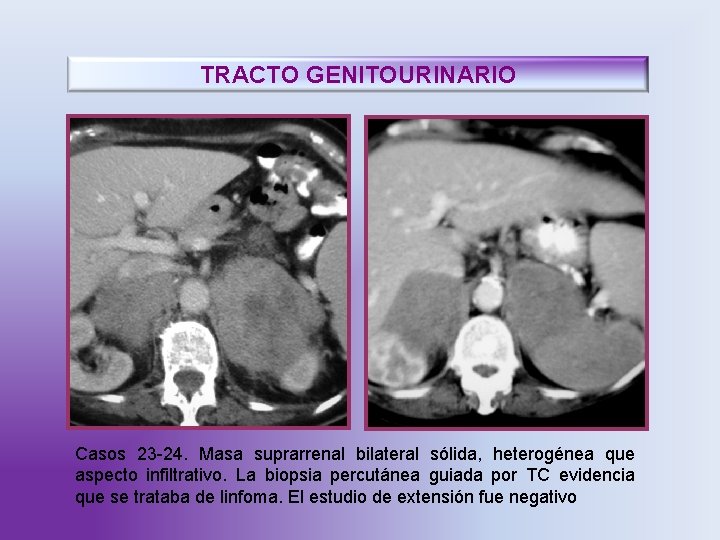 TRACTO GENITOURINARIO Casos 23 -24. Masa suprarrenal bilateral sólida, heterogénea que aspecto infiltrativo. La