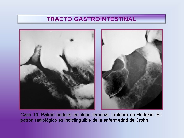 TRACTO GASTROINTESTINAL Caso 10. Patrón nodular en íleon terminal. Linfoma no Hodgkin. El patrón