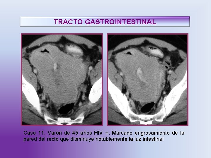 TRACTO GASTROINTESTINAL Caso 11. Varón de 45 años HIV +. Marcado engrosamiento de la